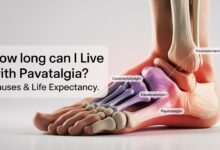 How Long Can You Live with Pavatalgia?